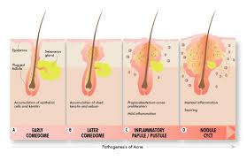 Acne Pathogenesis
